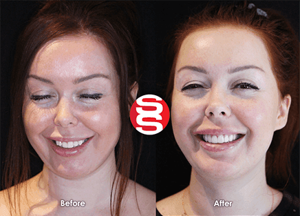 Porcelain Veneers